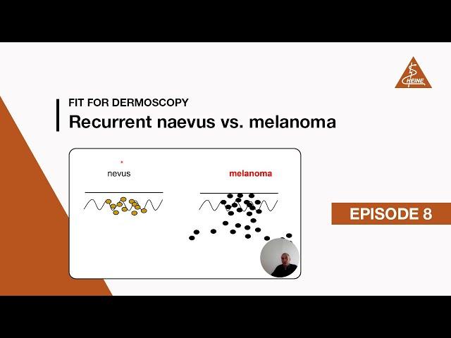 Fit for Dermoscopy Episode 8 – Recurrent naevus vs. melanoma