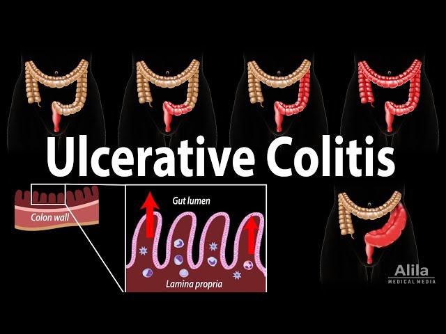 Ulcerative Colitis: Pathophysiology, Symptoms, Risk factors, Diagnosis and Treatments, Animation.