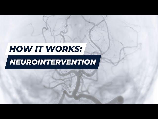 How Neurointervention Works | AuroraBayCare Interventional Neurology | Green Bay