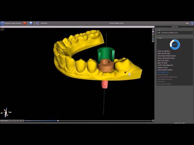 BSP WIZARD - CT to Surgical Guide in Minutes