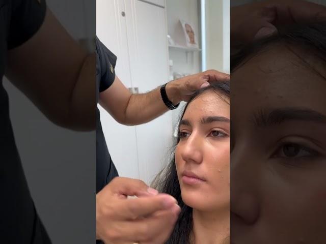 lip filler complete process with dr abbas ashrafzade