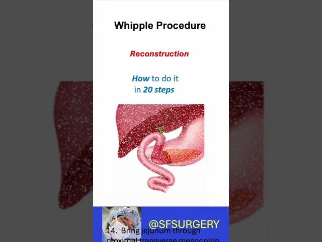 The Whipple Procedure (Pancreaticoduodenectomy): How To Do It (In Twenty Steps!)