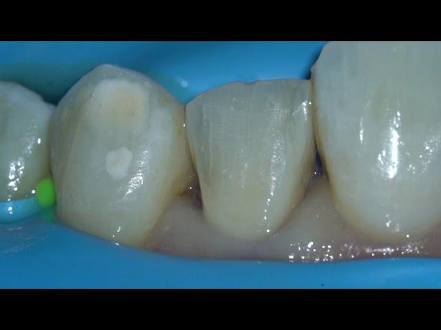 veneer preparation test one