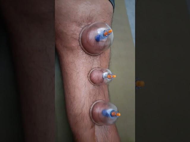 leg pain cupping therapy