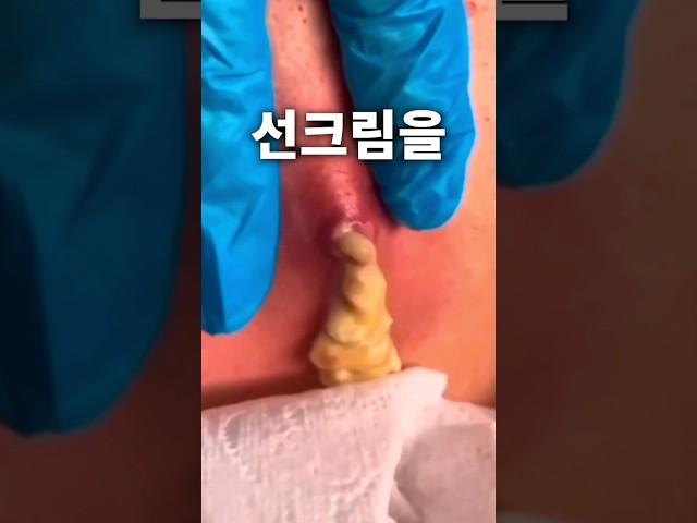 여드름 났을때 이렇게 선크림바르세요(이거 모르면 피부 망가집니다)