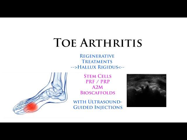 Toe Arthritis (MTP): Regenerative Stem Cells with Ultrasound-Guided Minimally-Invasive Injections