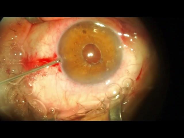 Replacement of dislocated IOL - case 2  (Замена дислоцированной ИОЛ, клиническое наблюдение 2)
