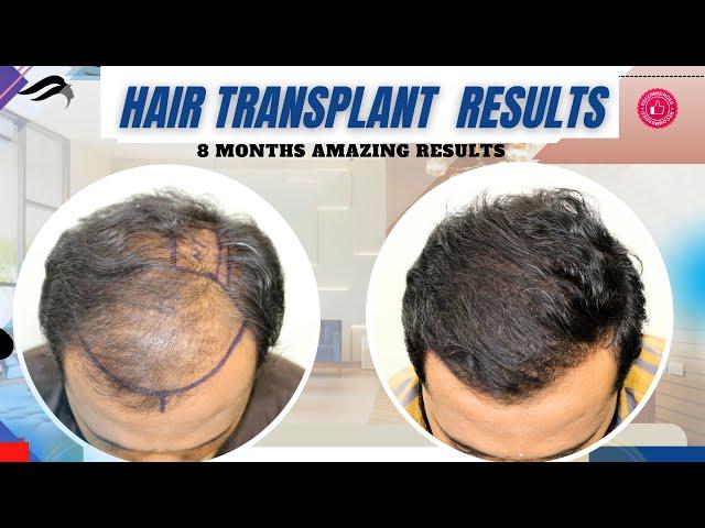 Hair Transplant In Kerala | Best Center Results Cost & Surgeon Of Hair Transplant In Kerala