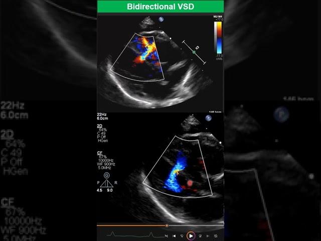 Bidirectional Ventricular Septal Defect- Early Stage of Eisenmenger Syndrome