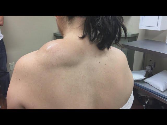 Watch This Life-Changing Lipoma Removal