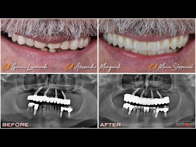 Intra Oral Scan flow,Jig deprogrammer, Michigan Bite, Monolithic Zirconia Toronto bridge