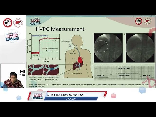 Portal Pressure Gradient (PPG) as a New Gold Standard in Portal Hypertension