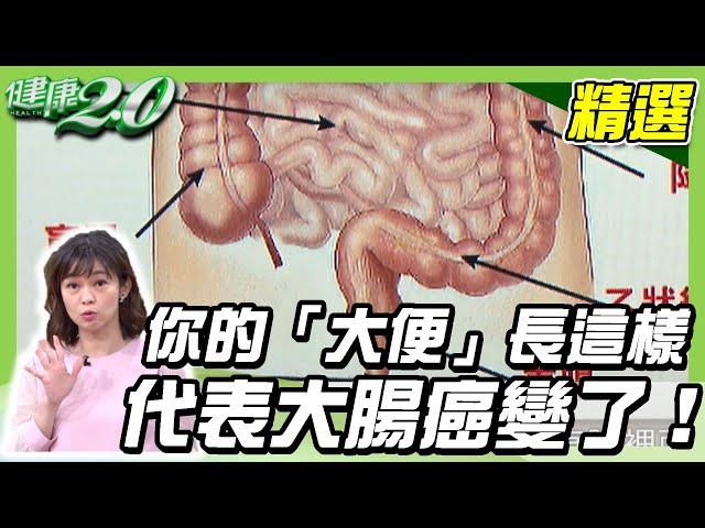 你的「大便」長這樣，代表大腸癌變了！名醫這樣吃遠離腸癌！【健康2.0精選】