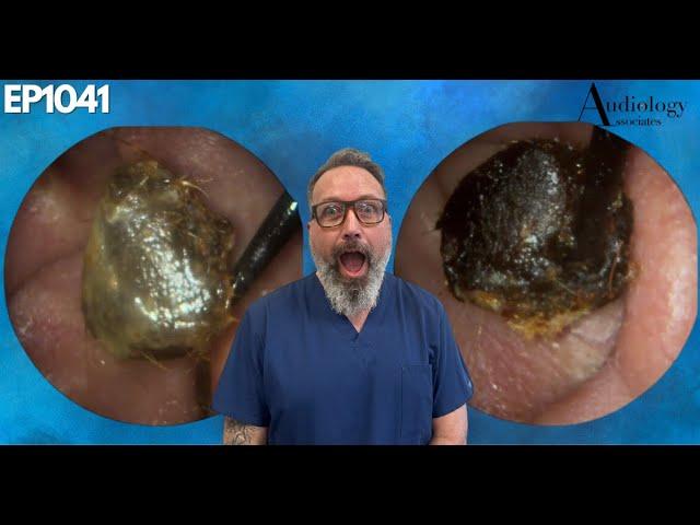 The Most Shocking Ear Wax Removal You've Never Seen - EP1041