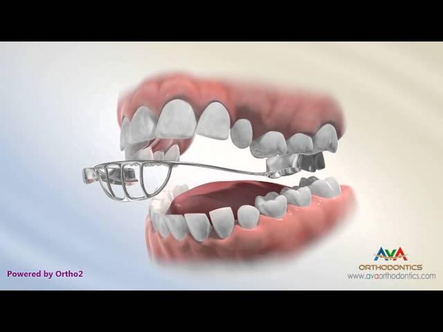 Orthodontic Treatment for Openbite - Upper Tongue Crib Appliance