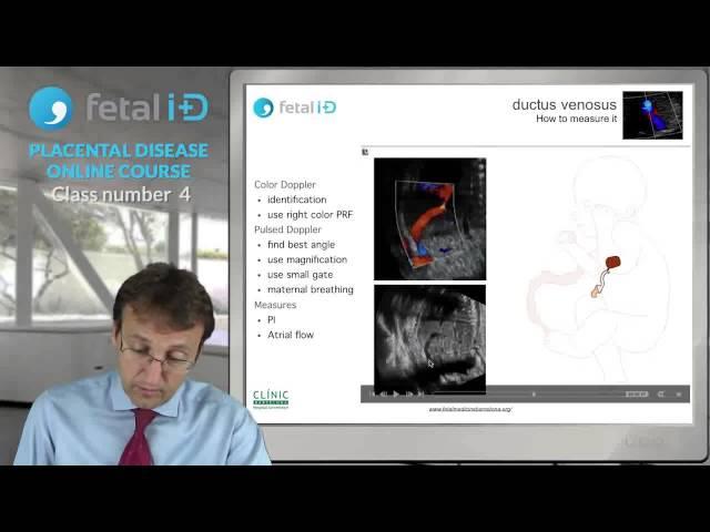 Лекция 4 Placental Disease Русский, Эдуард Гратакос, компания Альфамед.