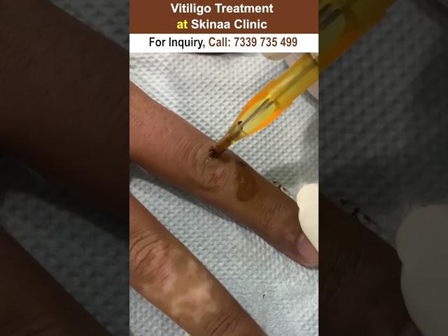 Vitiligo treatment at skinaa clinic #vitiligomodel #vitiligo #vitiligotreatment #skinaaclinic