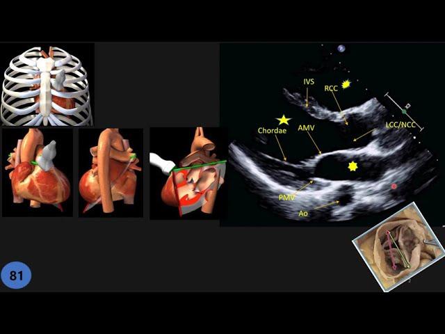 Echocardiographic Anatomy; Part 1: PLAX (Parasternal Long Axis)