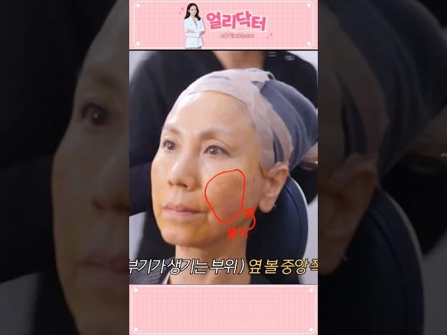 실리프팅 직후 공개