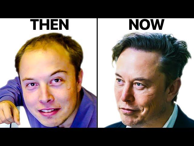 Elon Musk's Hair Transplant | Surgeon Reacts