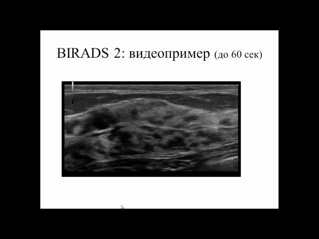 BIRADS: категоризация очаговых изменений молочных желез