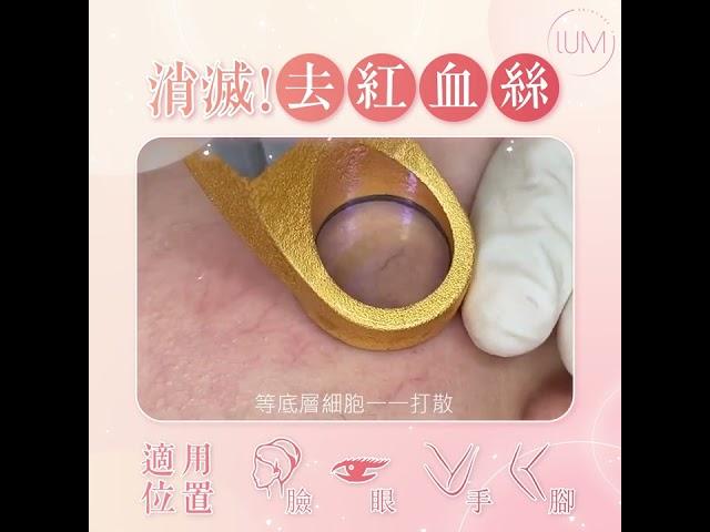 【微絲血管3】治療微絲血管 / 紅血管、青筋及色斑問題 / LUMI SKINCARE