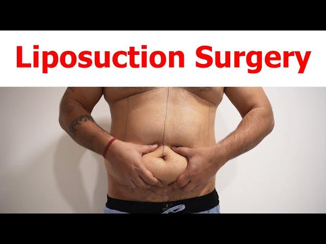 Liposuction | 360 Abdominal Liposuction | liposuction in delhi | Dezire Clinic