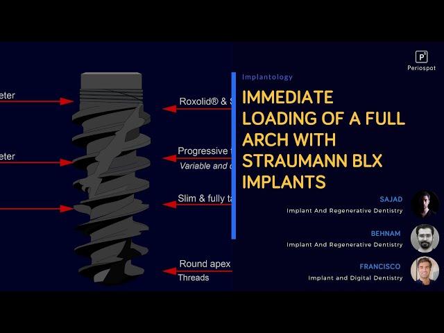 Full arch surgery with BLX implants and with immediate loading after digital impressions.