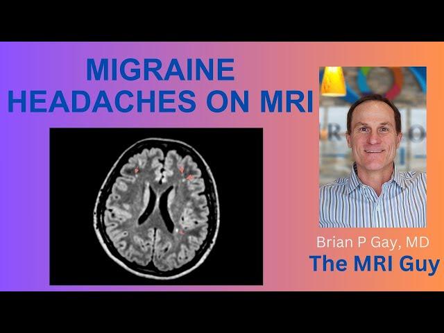 Migraine headaches on MRI
