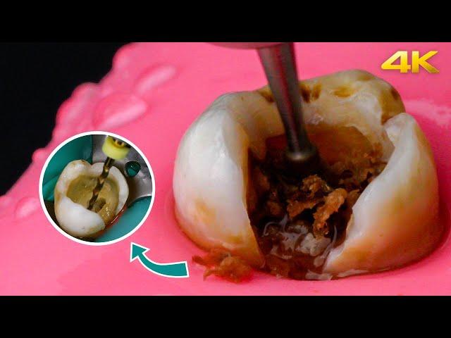 AMAZING Root Canal Treatment Process in 4k!