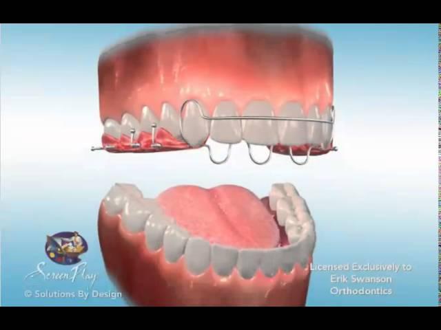 ES Ortho and AOB (Anterior Open Bite) Retainers