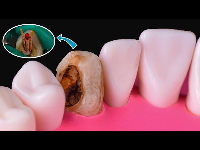 Amazing Canine Root Canal Treatment