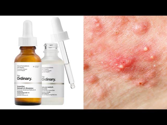 Top 7 Ordinary Skincare For Acne + How To Use