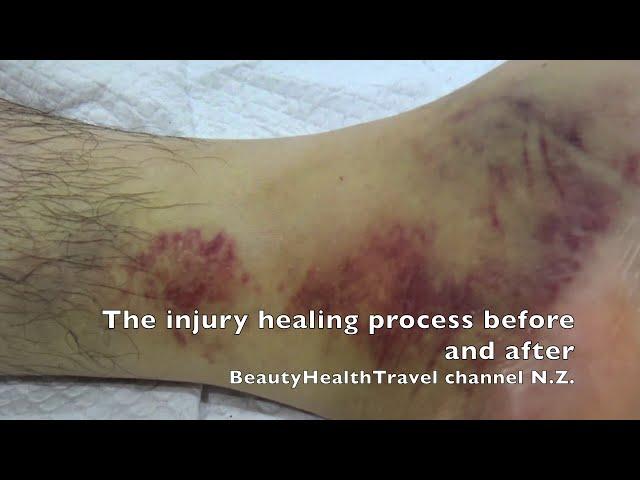 Injury healing home remedy before and after