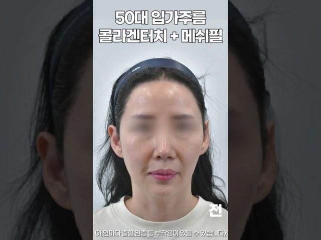 50대 마리오넷주름, 입가처짐 한달 후 변화 #콜라겐주사 #shorts