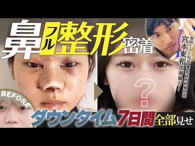 【鼻整形】鼻整形しようか迷っている方必見！施術シーンから術後のダウンタイムまで公開！【福岡TAクリニック】