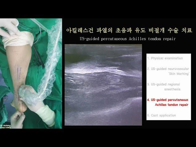 221.(의사용.Achilles rupture.통합본) Kang’s method: US-guided percut repair. A to Z [강찬.정형외과.충남대병원.Chan]