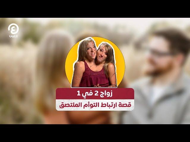 زواج 2 في 1.. قصة ارتباط التوأم الملتصق