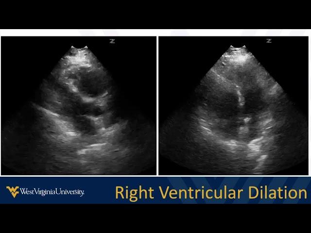 POCUS in Acute Dyspnea 2 - Heart and Lung Review