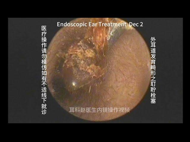 Embolization of earwax in the development of abnormal external auditory canal 20241202