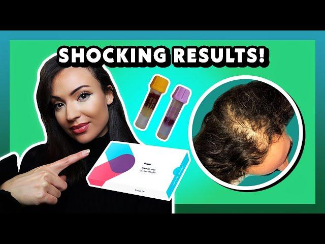 Blood Work and Hair Loss (Thriva blood test hair loss diagnosis + anti-hair loss action plan)