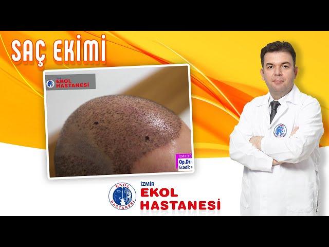 İzmir Ekol Hastanesi - Saç Ekimi