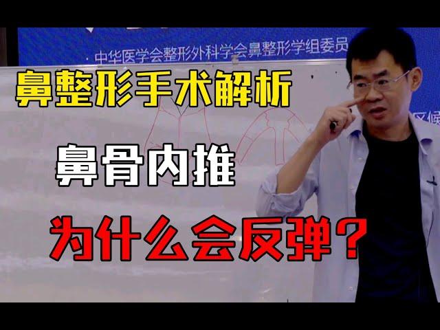 【鼻整形】鼻骨的截骨内推有哪些方式？为什么有些人做完之后会反弹没效果？