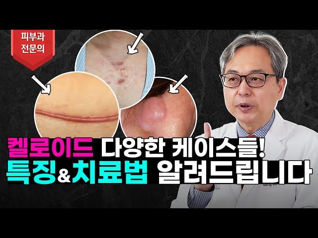 켈로이드의 다양한 케이스들! 각각에 맞는 특징과 치료법 알려드리겠습니다! #켈로이드