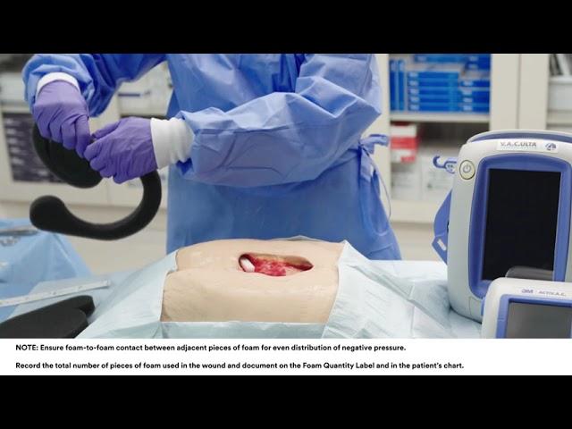 3M™ V.A.C.® Simplace™ Dressing Application on Sacral Pressure Ulcer