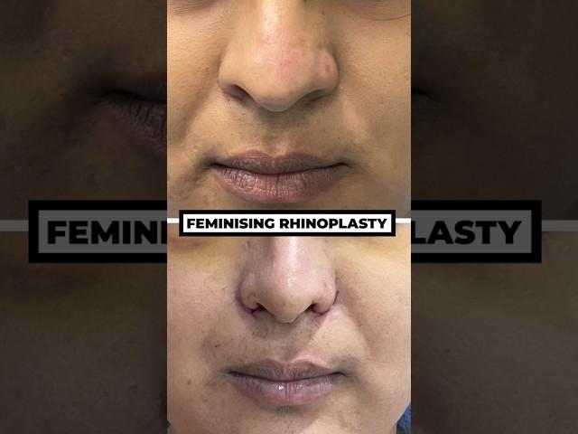 Feminising Rhinoplasty vs Regular Rhinoplasty | Rhinoplasty Surgery in Mumbai | Dr. Parag Telang