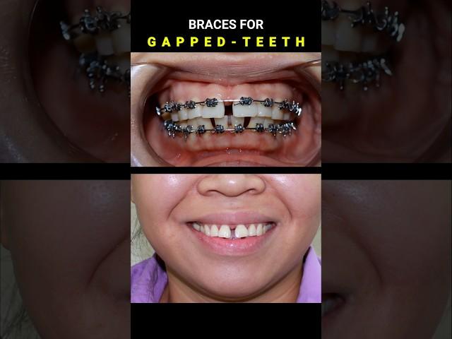 BRACES FOR GAPPED TEETH. 32 MONTHS DURATION #braces #orthodontist #dentist