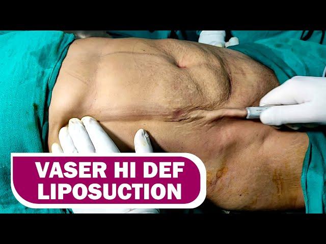 360° Abdomen Liposuction & Back Liposuction. VASER Hi Def Lipo #dezireclinic