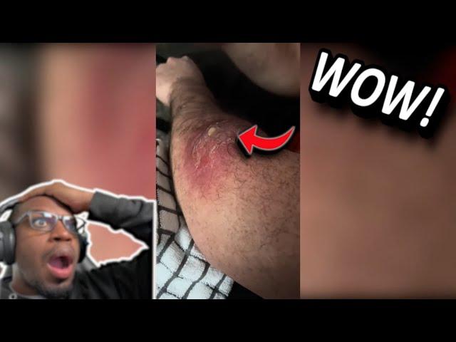 He Needs a Doctor NOW! | Pimple Popping and Blackhead Popping Compilation
