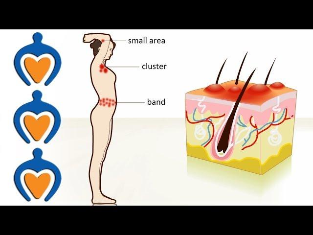 Shingles - The causes, symptoms, treatment and prevention